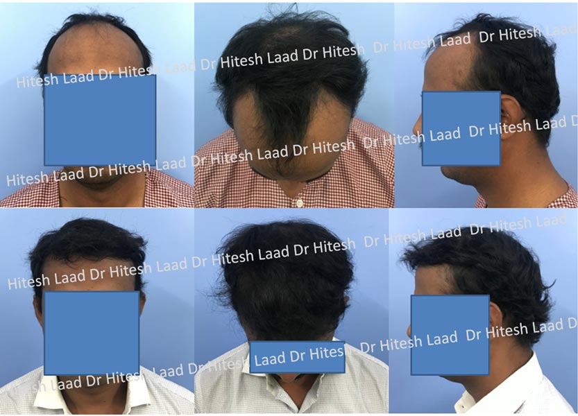 hair transplant case-1