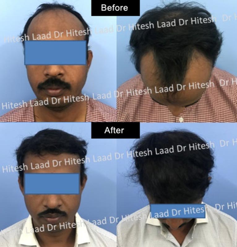 hair transplant case-2